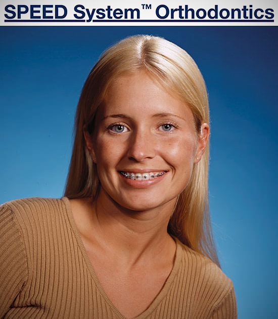 Selbstligierende Brackets
