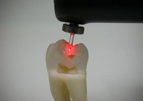Karies Laserdiagnostik