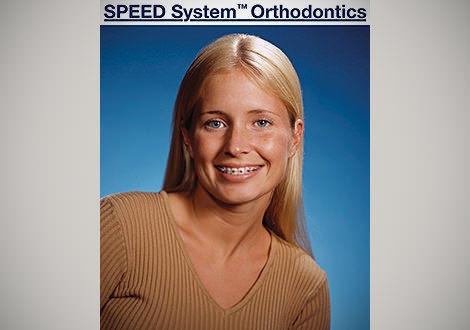 Selbstligierende Brackets
